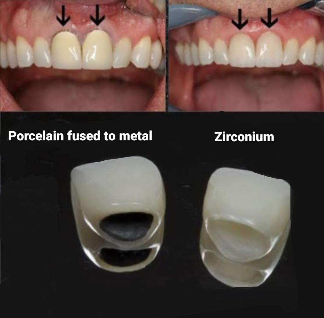 Best crown for upper front tooth 